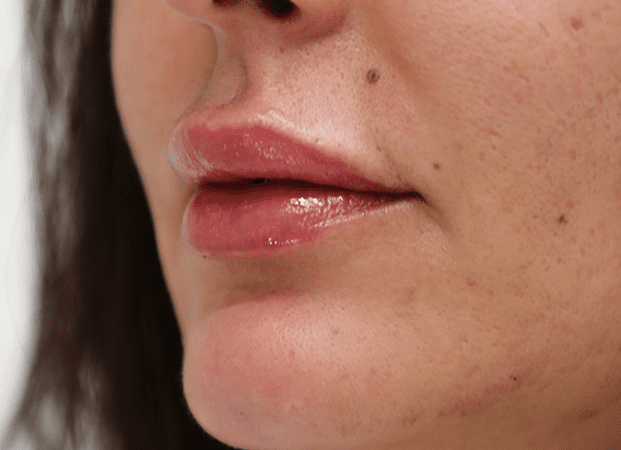 lip-fillers