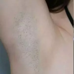 Laser Hair Removal Cost