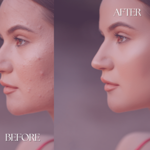 London Aesthetics skin care before and after 