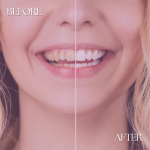 London Aesthetics tooth whitening before and after 